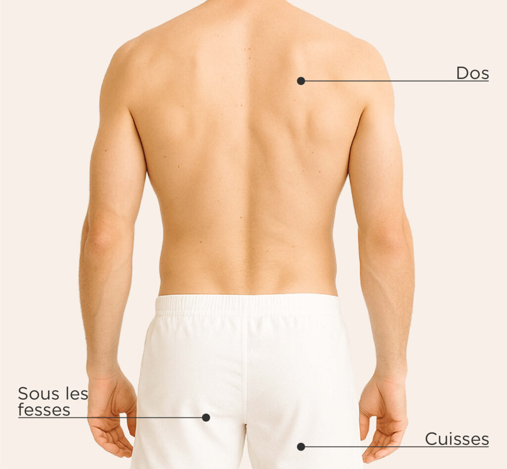 Zones traitables pour le traitement CoolSculpting ELITE chez l’homme : dos, sous les fesses, cuisses.