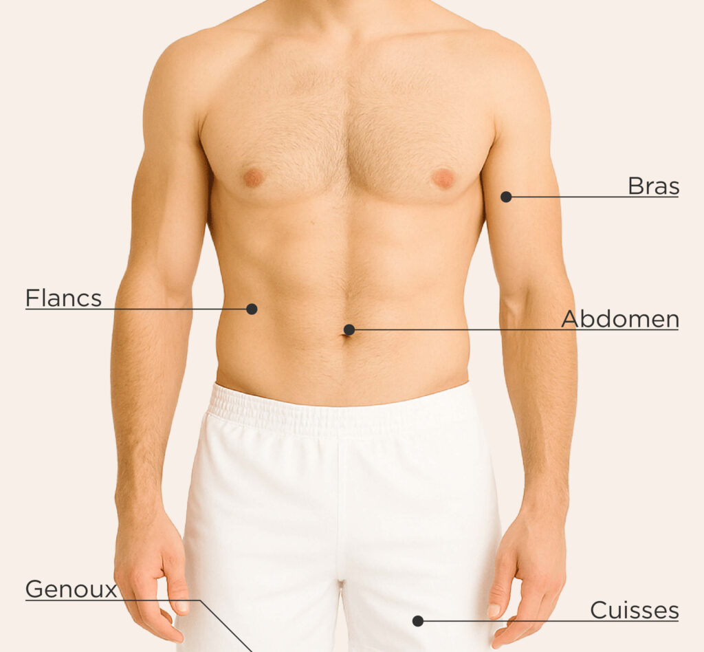 Zones traitables pour le traitement CoolSculpting ELITE chez l’homme : bras, flancs, abdomen, cuisses, genoux.