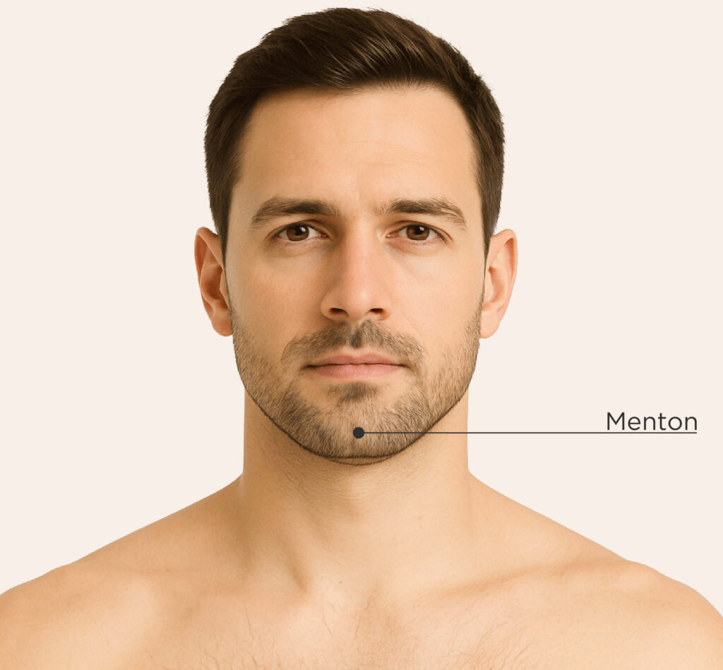 Zone traitable pour le traitement CoolSculpting Elite chez l’homme : menton