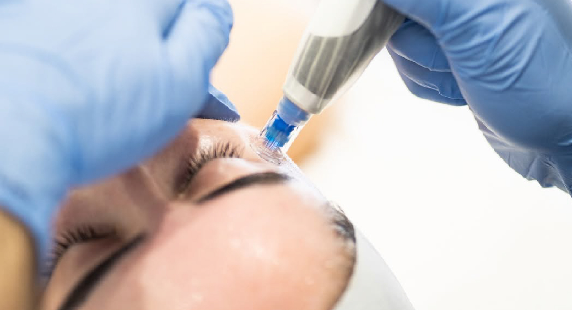 Application d’un soin aux exosomes sur le visage à l’aide d’un dispositif de microneedling médical