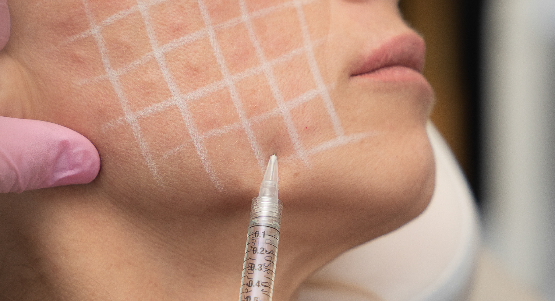Injection de GlowTox pour une peau plus lumineuse et uniforme