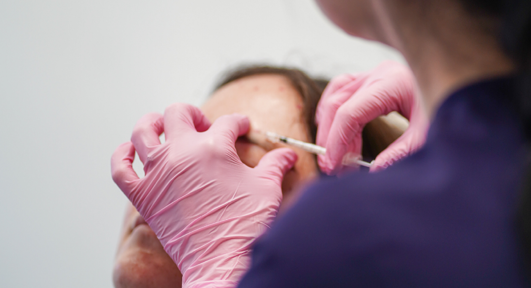Gros plan sur une injection esthétique au front réalisée par une professionnelle portant des gants roses.