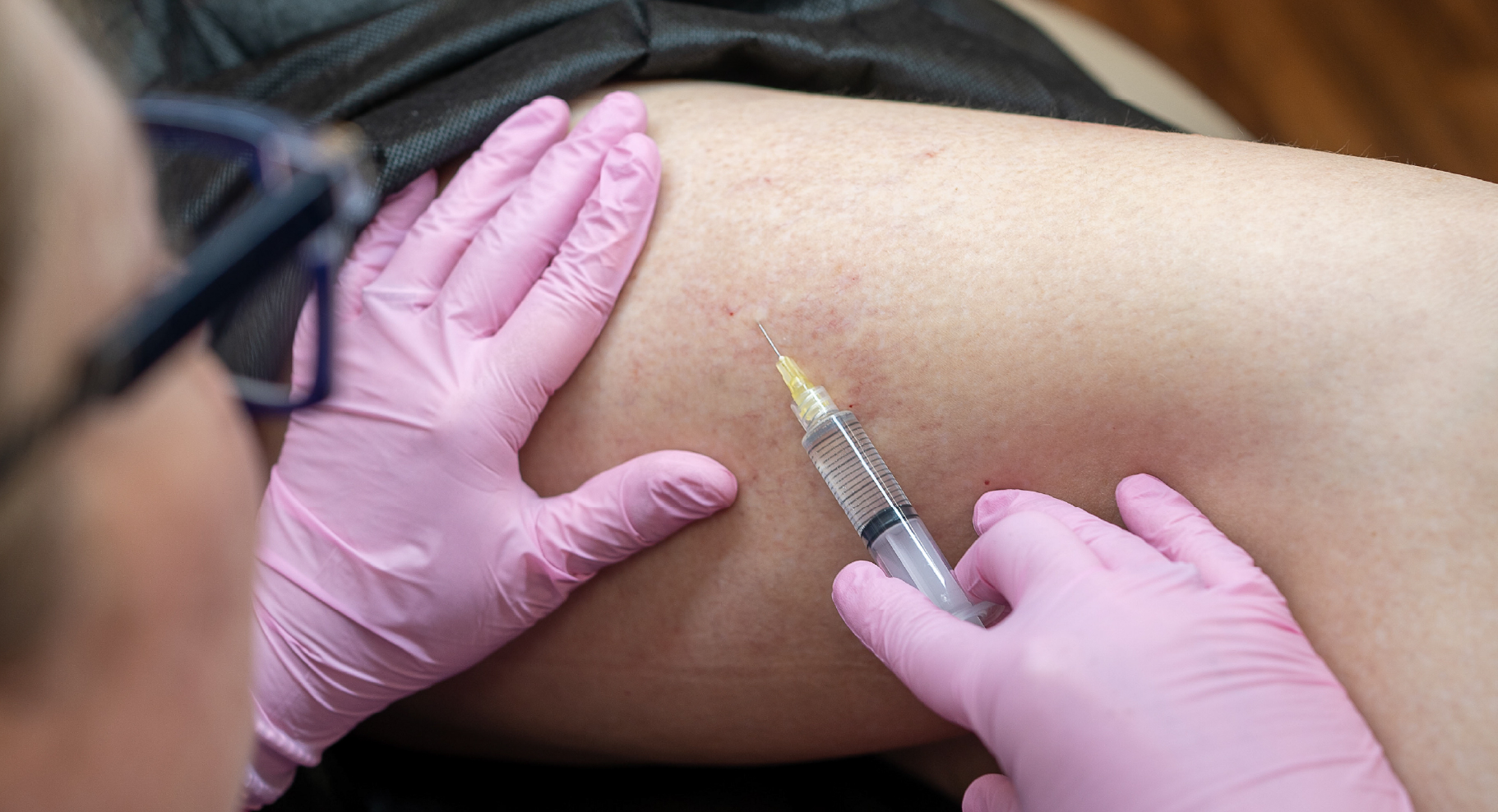 Injection de sclérothérapie pour traiter les varicosités superficielles des jambes.