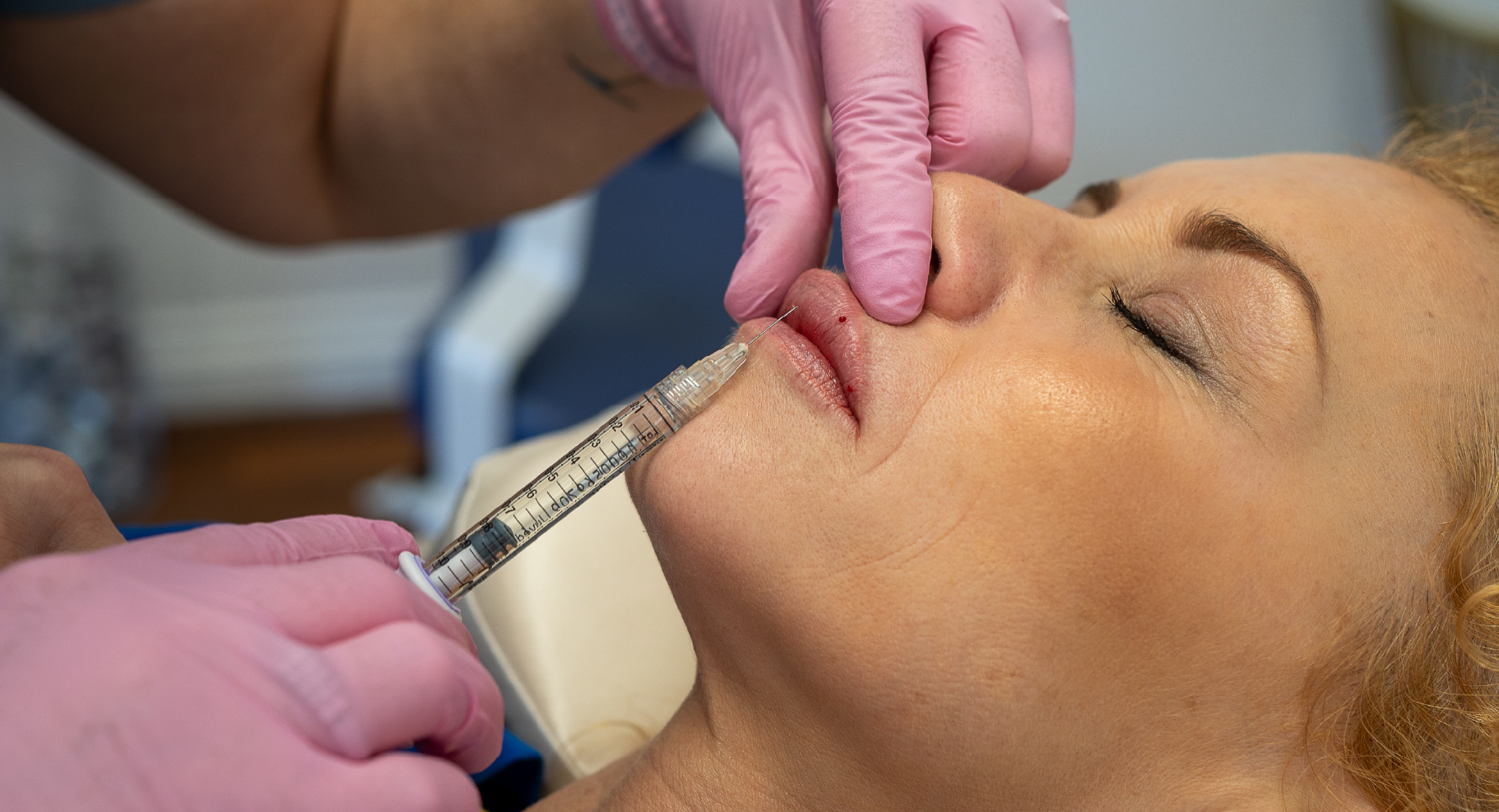 Injection de volumisant pour les lèvres – traitement esthétique de comblement pour redonner volume et définition.