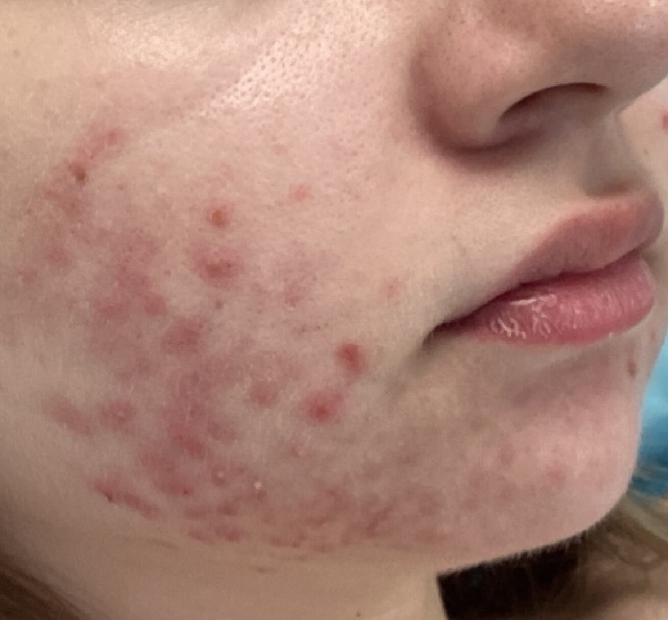 Acné inflammatoire modérée à sévère sur la joue d’une femme, avec papules, pustules et rougeurs visibles
