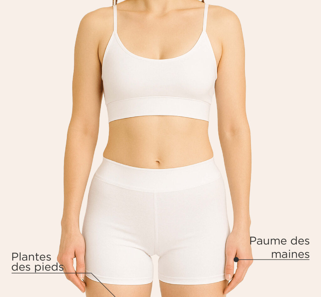 Zones de traitement de l’hyperhidrose chez la femme : transpiration excessive des mains et des pieds traitée par injection.