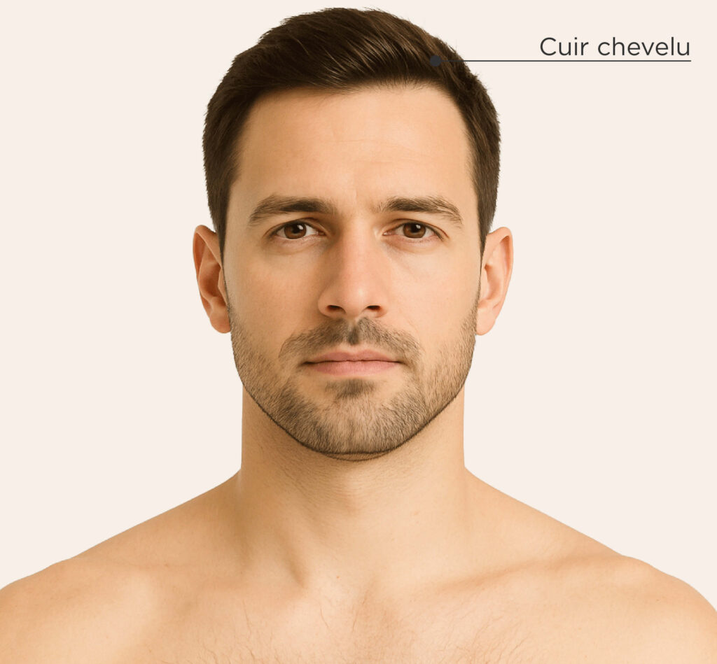 Zones de traitement de l’hyperhidrose chez l’homme : cuir chevelu, aisselles, mains, pieds.