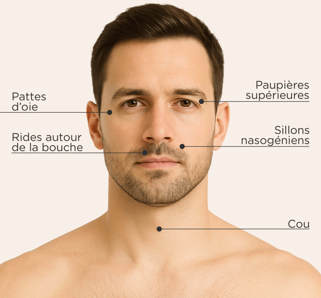 Zones traitables pour le traitement Plasma IQ chez l’homme : pattes d’oie, paupières supérieures, sillons nasogéniens, rides autour de la bouche, cou.