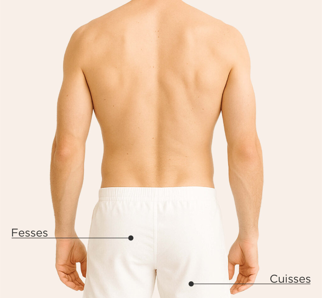 Zones traitables avec Sculptra chez l’homme : fesses et cuisses.