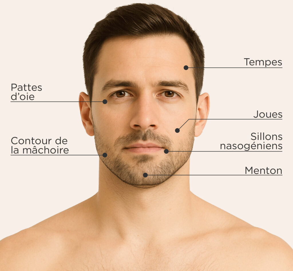 Zones traitables avec Sculptra sur le visage masculin : tempes, pattes d’oie, joues, sillons nasogéniens, menton, contour de la mâchoire.