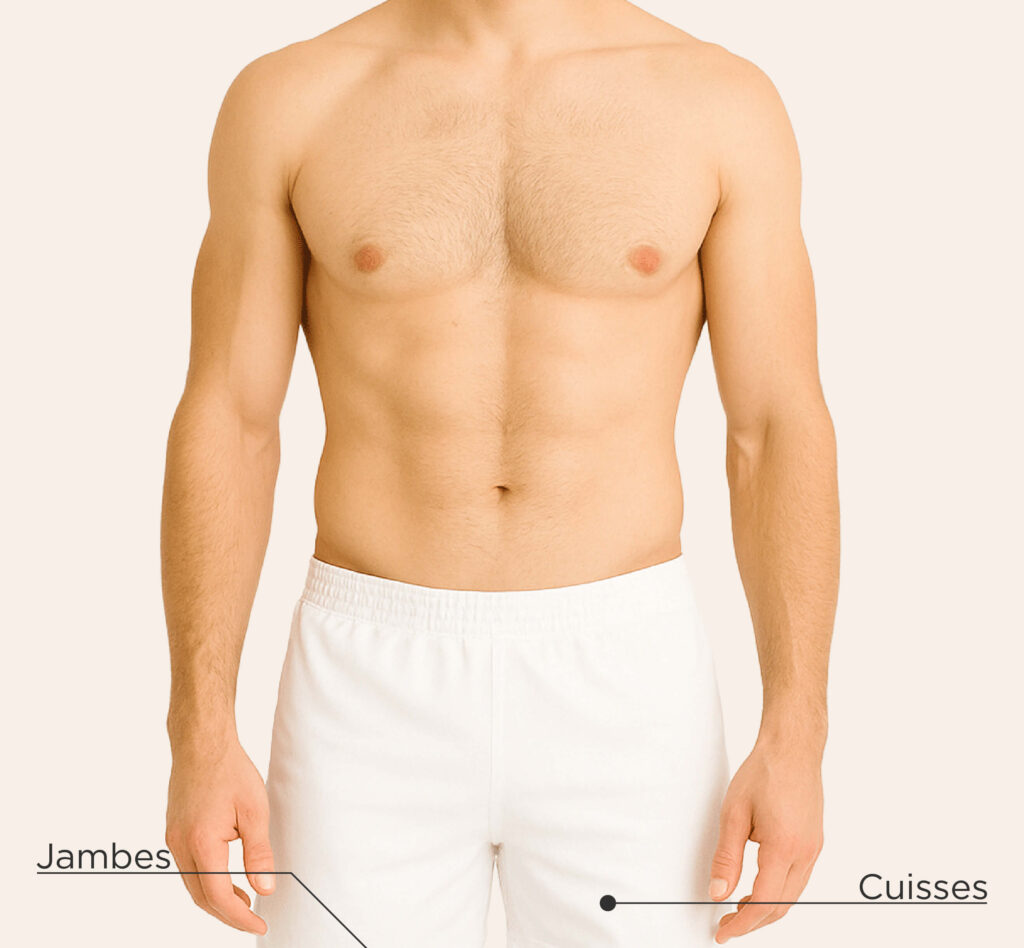 Zones traitables chez l’homme pour le traitement par sclérothérapie : jambes, cuisses.