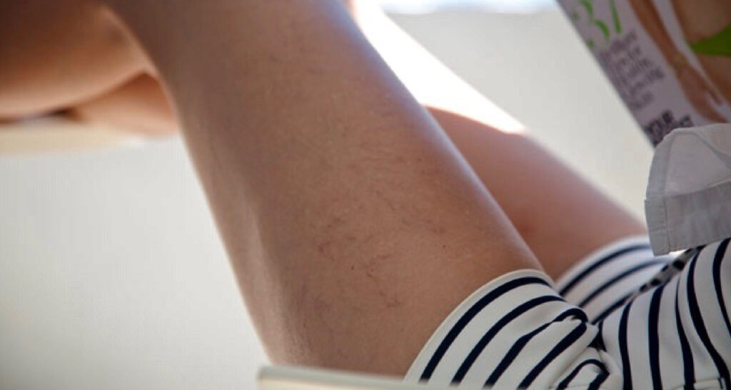 Varicosités visibles sur les cuisses — un exemple fréquent pris en charge en sclérothérapie.