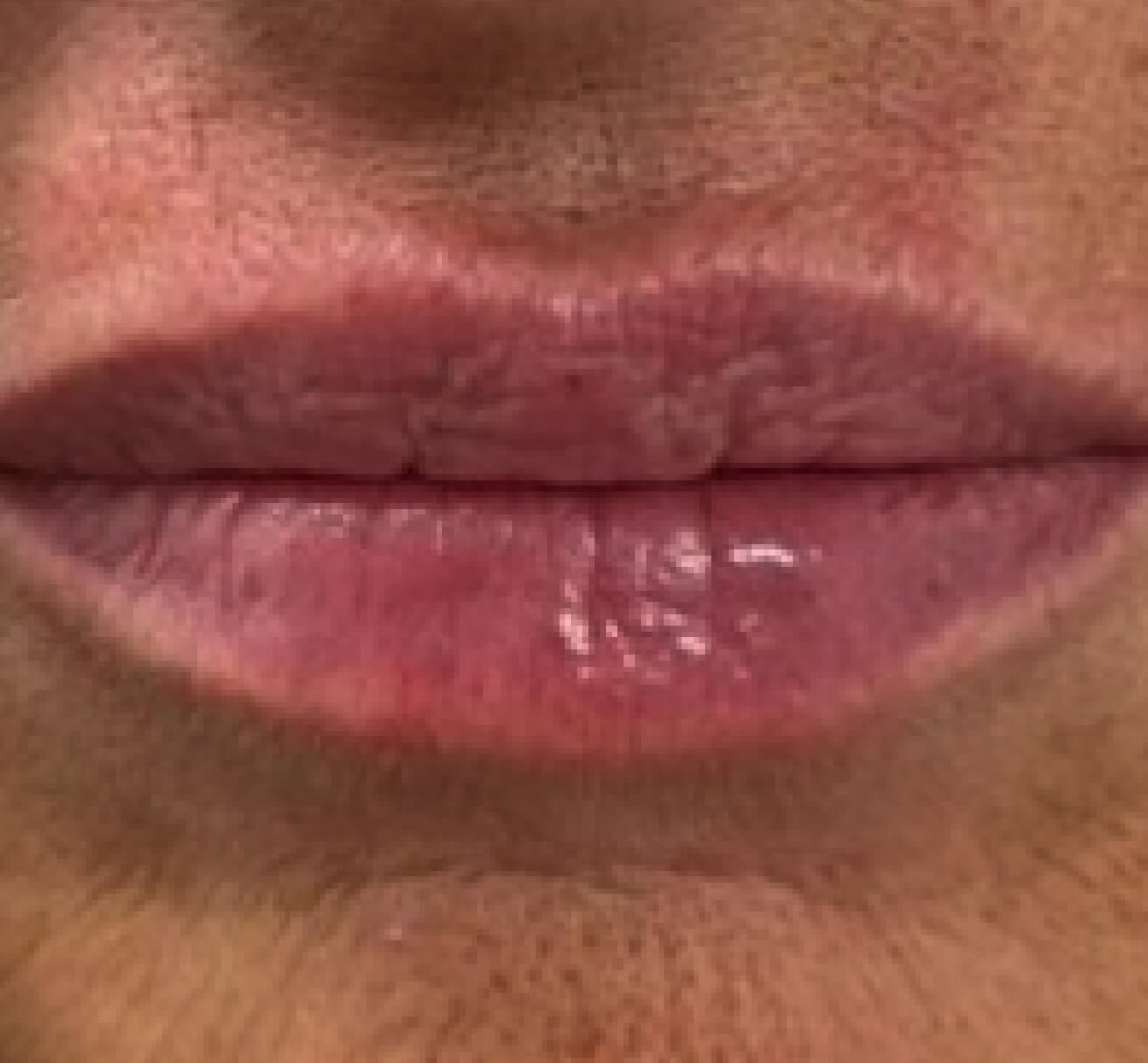 Résultat après injection de volumisant à l’acide hyaluronique dans les sillons nasogéniens et les plis d’amertume : volume restauré, contour de la bouche adouci et apparence rajeunie.