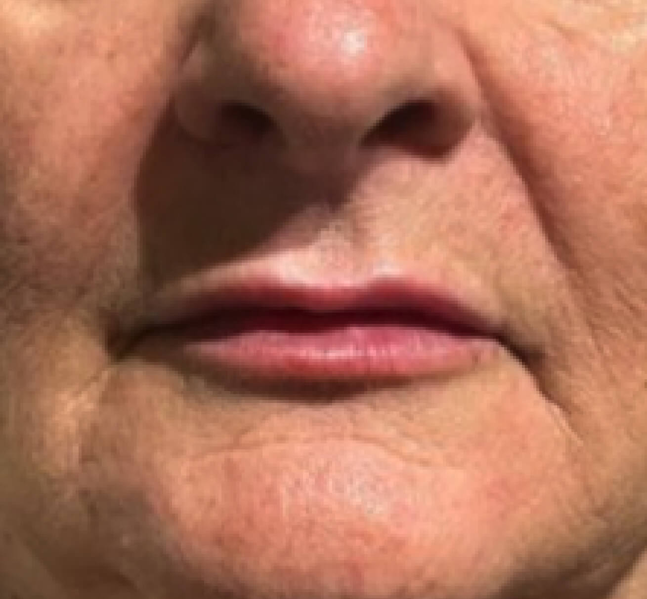 Résultat après injection de volumisant à l’acide hyaluronique dans les sillons nasogéniens et les plis d’amertume : volume restauré, contour de la bouche adouci et apparence rajeunie.