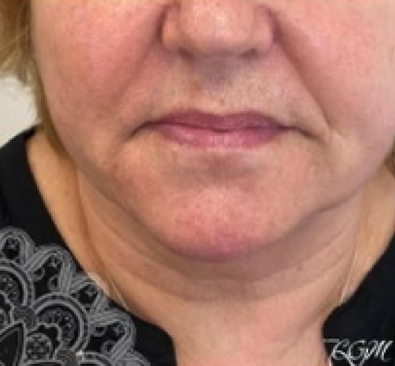 Résultat après injection de volumisant à l’acide hyaluronique dans les sillons nasogéniens et les plis d’amertume : volume restauré, contour de la bouche adouci et apparence rajeunie.