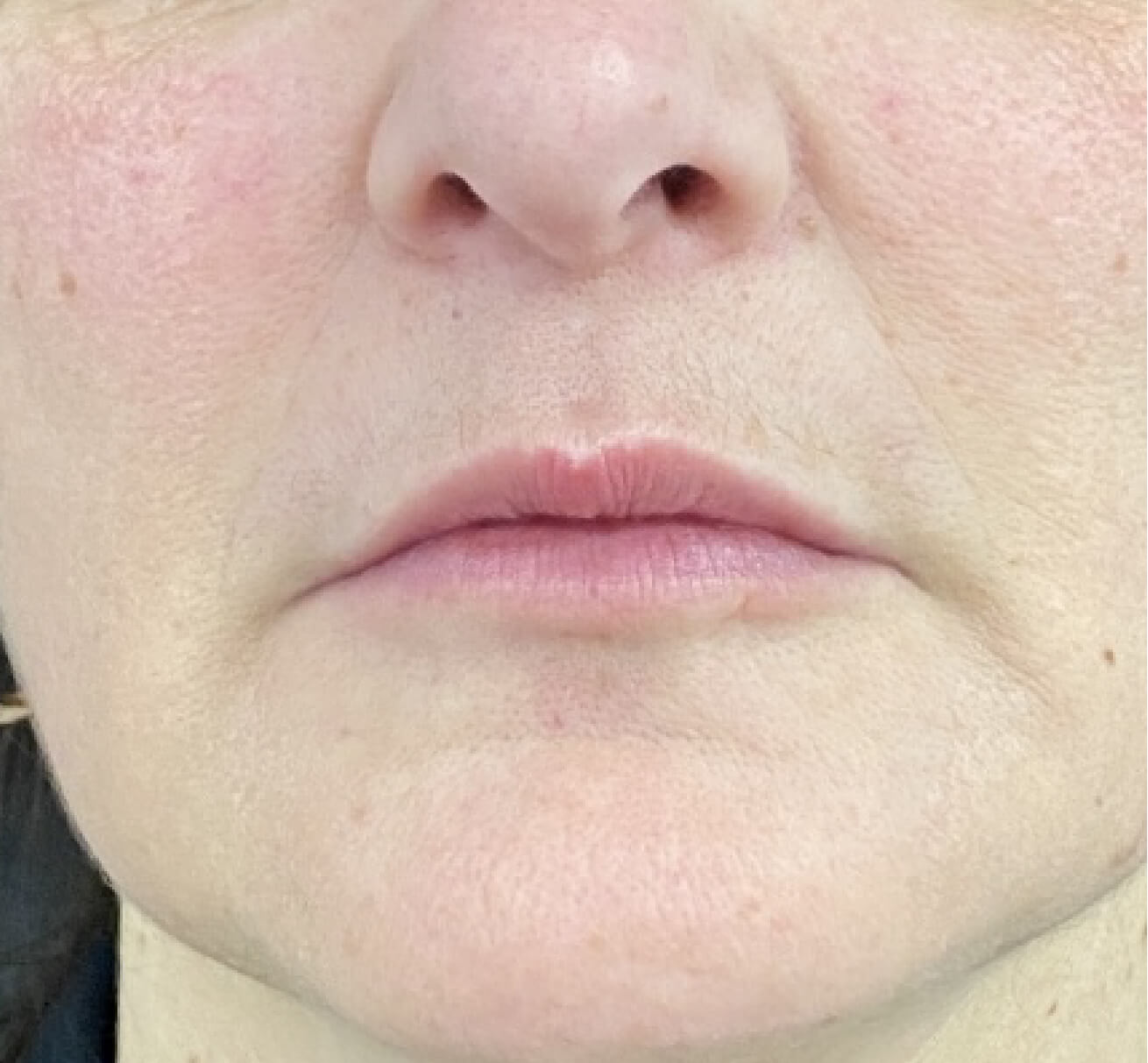 Résultat après injection de volumisant à l’acide hyaluronique dans les sillons nasogéniens et les plis d’amertume : volume restauré, contour de la bouche adouci et apparence rajeunie.