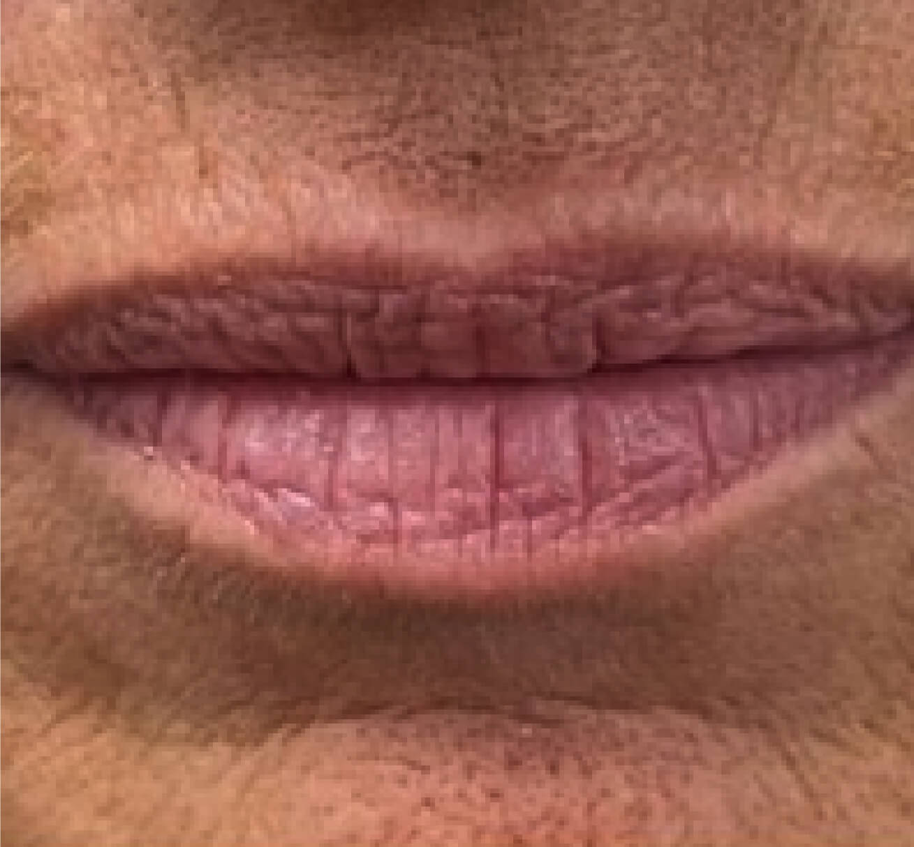 Visage de patiente avant une injection de volumisant à l’acide hyaluronique visant à restaurer les volumes des lèvres
