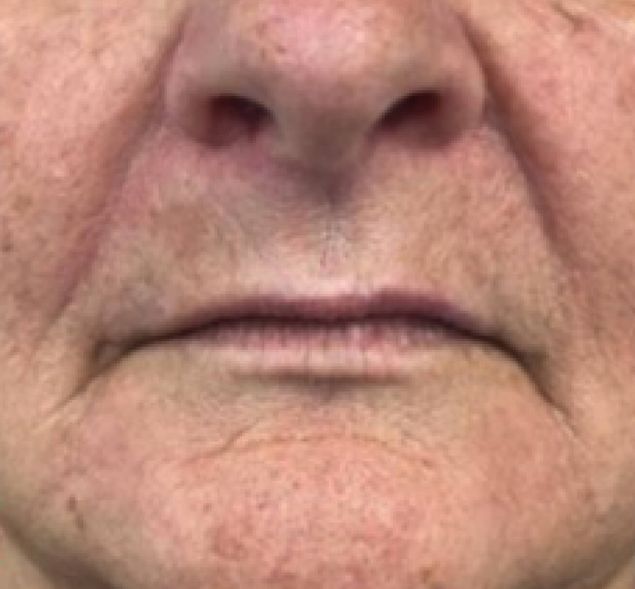 Visage de patiente avant une injection de volumisant à l’acide hyaluronique visant à restaurer les volumes des lèvres