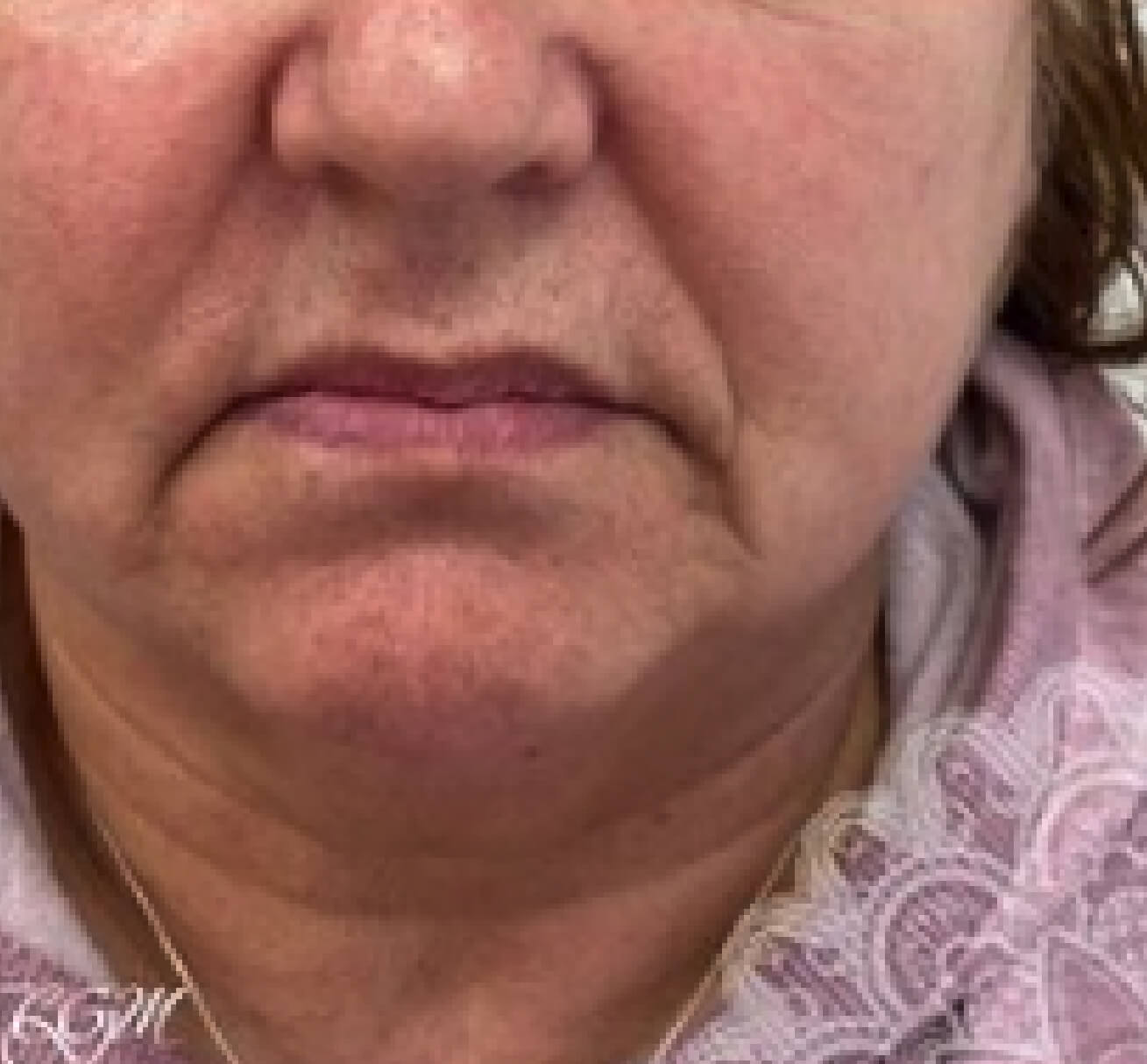 Visage de patiente avant une injection de volumisant à l’acide hyaluronique visant à restaurer les volumes des lèvres