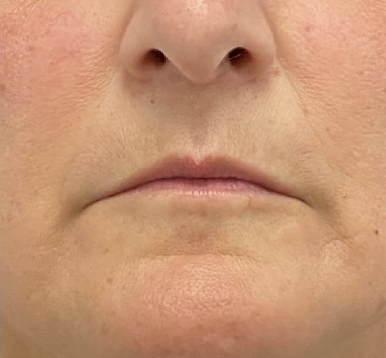 Visage de patiente avant une injection de volumisant à l’acide hyaluronique visant à restaurer les volumes des lèvres