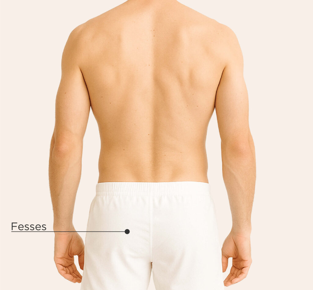 Zones traitables pour le traitement à l’acide hyaluronique chez l’homme : fesses.