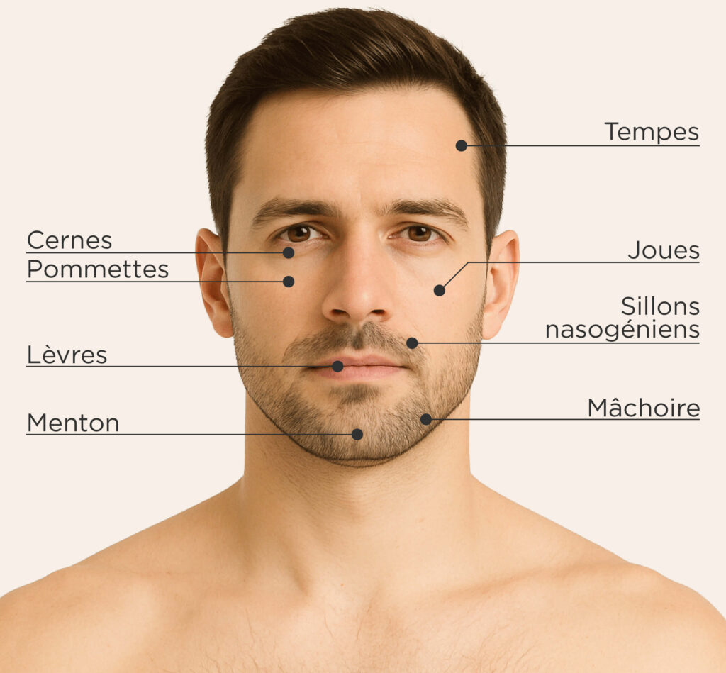 Zones traitables pour le traitement à l’acide hyaluronique chez l’homme : tempes, cernes, pommettes, joues, sillons nasogéniens, lèvres, menton, mâchoire.