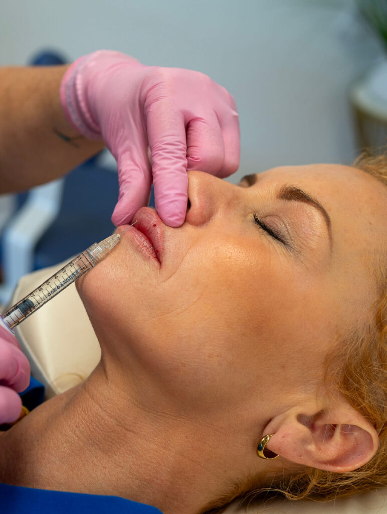 Injection d’acide hyaluronique dans les lèvres pour un rehaussement naturel, réalisée à la Clinique médico-esthétique CGM.