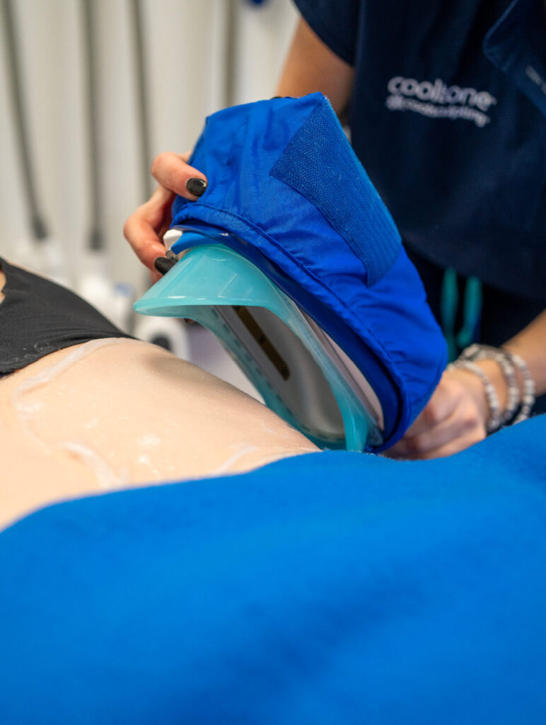 Application de l’applicateur CoolSculpting Elite sur l’abdomen d’un patient pour une séance de cryolipolyse à la Clinique médico-esthétique CGM.