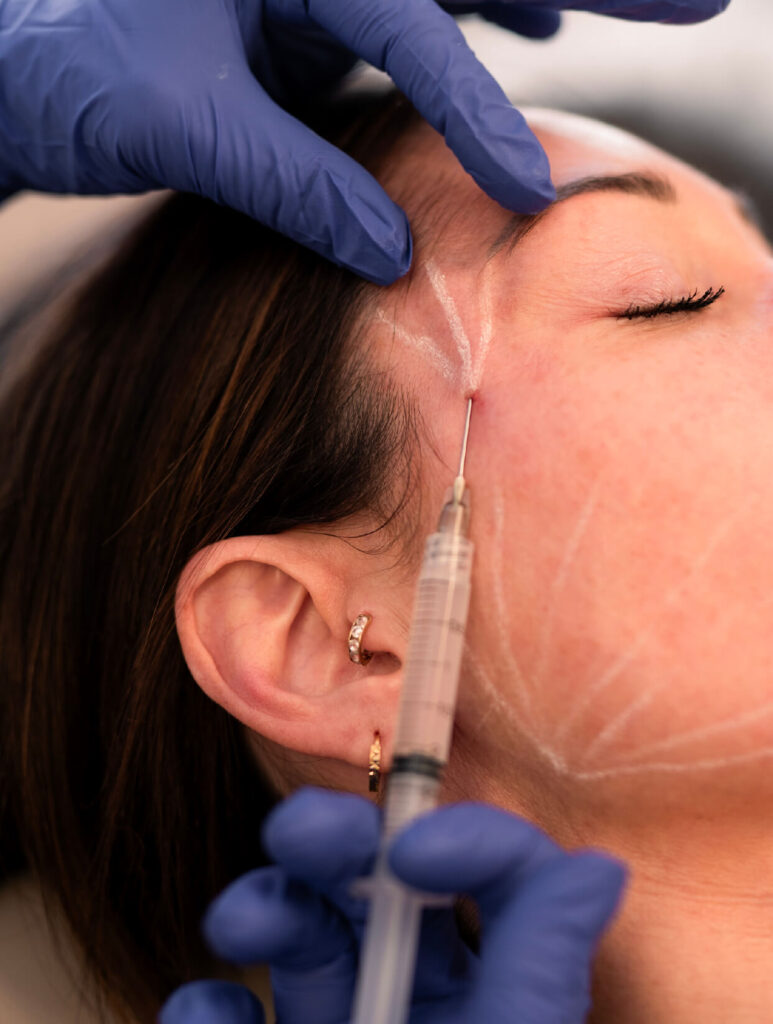 Injection d’acide hyaluronique au niveau de la tempe pour restaurer les volumes du visage, réalisée à la Clinique médico-esthétique CGM.